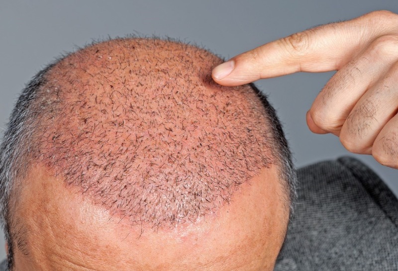 Stress & Hair Loss: The Ultimate Guide by a Hair Loss Doctor