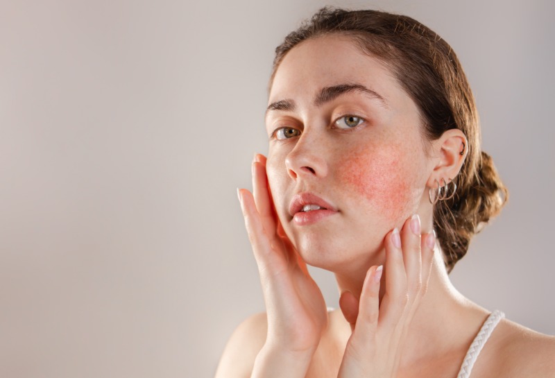 What is the Best SPF for Rosacea?