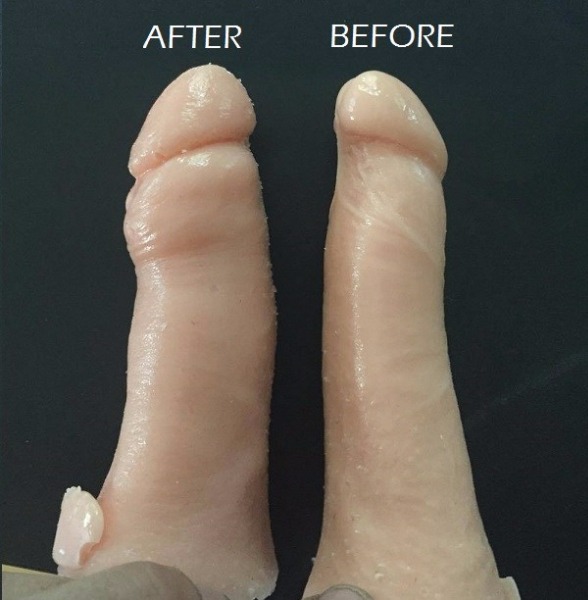 Penis Surgery Before After 32