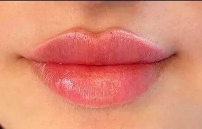 After lip filler treatment