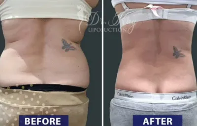 Before and after hip/love handle treatment