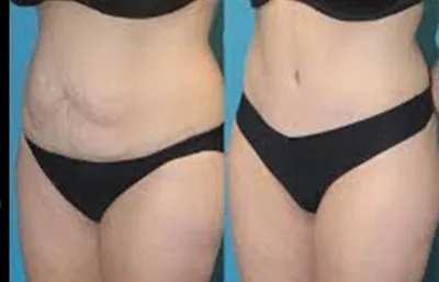 Before and after Liposuction treatment