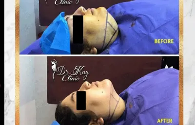 Chin contouring before and after