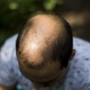 Hair Loss ( Male Pattern Baldness, Alopecia )