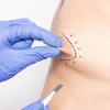 Breast Nipple Surgery