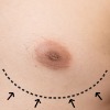 Breast Reduction (Male Gynaecomastia)