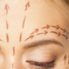Brow Lift (Surgical)