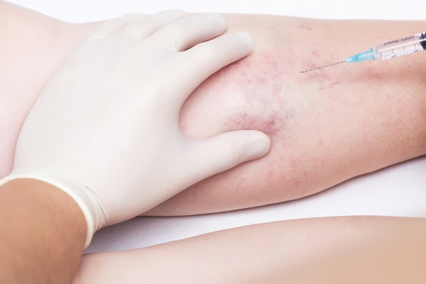 Sclerotherapy and Microsclerotherapy Information Image