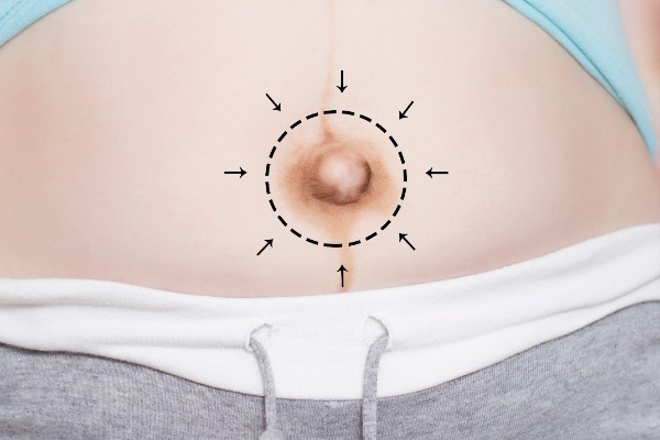 Umbilicoplasty or Navel, Belly Button Surgery Information Image