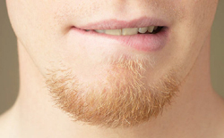 Facial Hair Transplants