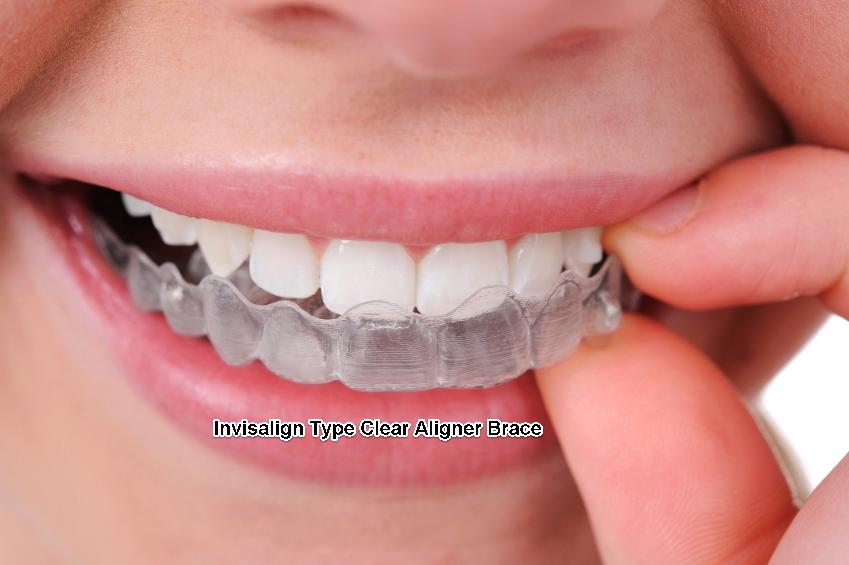 Straightening your smile Braces for adult teeth explained
