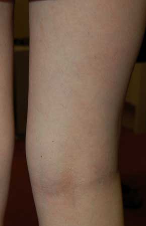 Reticular Veins After Treatment - Sclerotherapy