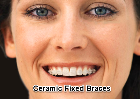 Adult Teeth Braces 70