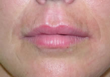 After Teosyal treatment