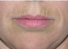 Before Teosyal treatment