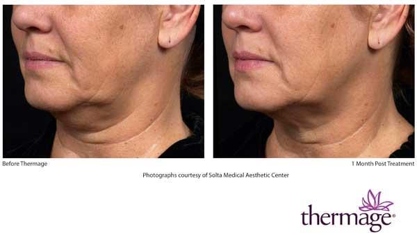Before and After Thermage Neck Treatment