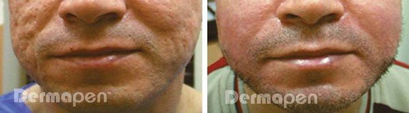 Before and after Dermapen on Acne scarring