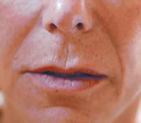 Before treatment with Teosyal