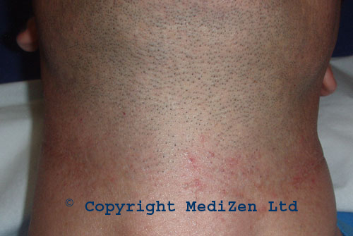 Male beard line before laser hair removal for pesistent shaving rash