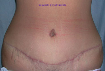 Marks Before Abdominoplasty Tummy Tuck Surgery And 6 ...