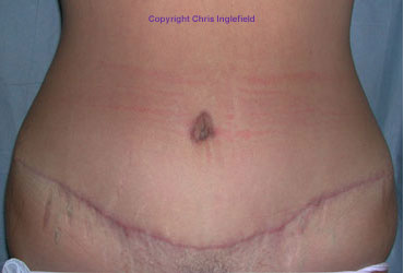 Post Tummy Tuck Surgery Front