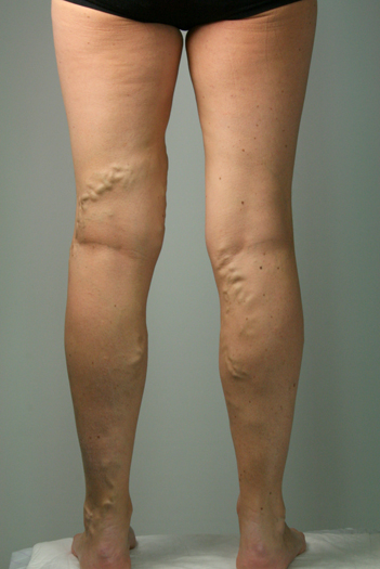 Female-Back-Legs-Varicose-Veins-Before.jpg