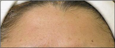 Forehead After Hydrafacial Treatment