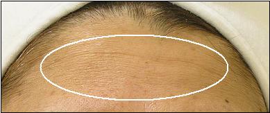 Forehead Before Treatment