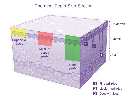 tca chemical peel. Chemical Peels Skin Section