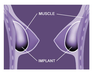 http://www.consultingroom.com/uploads/Image_Directory/Treatment_FAQs/TDBreastimplantsposition090403.jpg