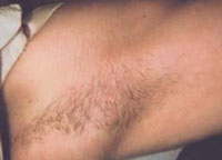 Female with underarm hair before treatment.