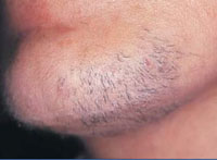 Female with facial hair before treatment.
