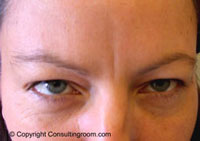 After Botox Treatment 