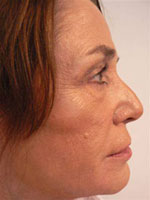 After Evolence Treatment - Mid face volume loss.