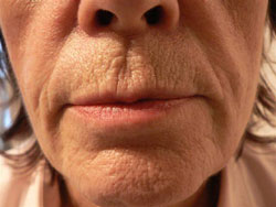 Before Evolence Treatment - Peri-oral lines around the mouth.