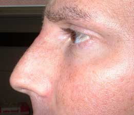 Male nose reshaped with dermal filler treatment with Succeev