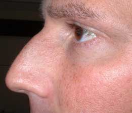 Male nose before reshaping with dermal fillers