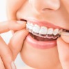 Invisalign ®