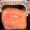 ThermaVein™