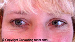Patient smiling 7 days following Botox® injections to her right eye only