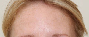 Female forehead 14 days post botulinum toxin treatment.
