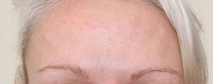 Female forehead 14 days post botulinum toxin treatment.