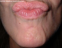 Popply chin after Botox treatment