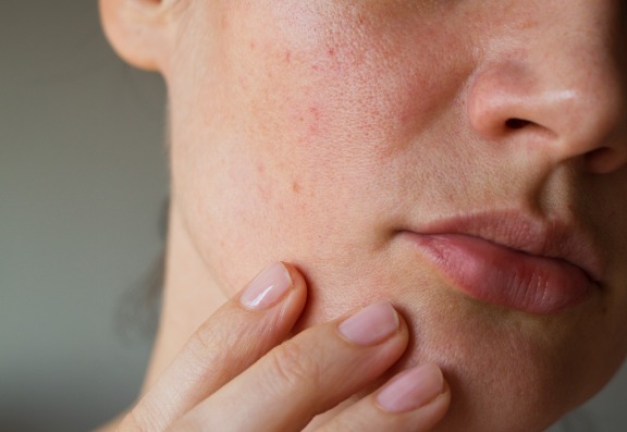 Oily / Acne-prone Skin
