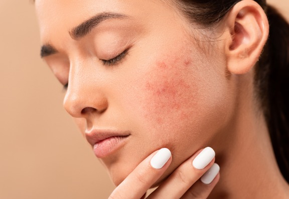 Understanding Why we Get Acne Scarring and Knowing How to Prevent it Understanding Why we Get Acne Scarring and Knowing How to Prevent it