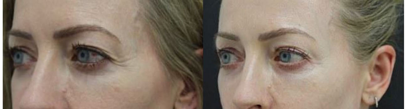 Eyes crows feet