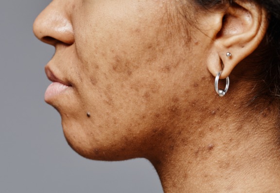 Your Skin Tone Matters: Fitzpatrick Types and Scarring Tendencies