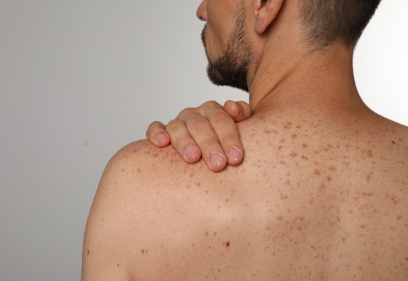 Skin cancer is more common and can be more fatal in men