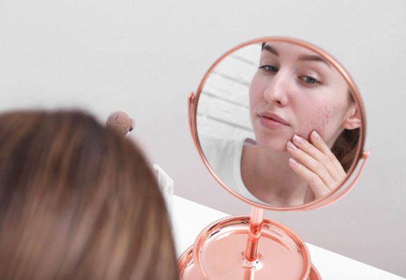 Where typically does hormonal acne occur?