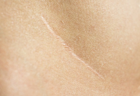 Types of Acne Scars